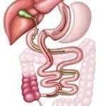 SIPS procedure is based on duodenal switch
