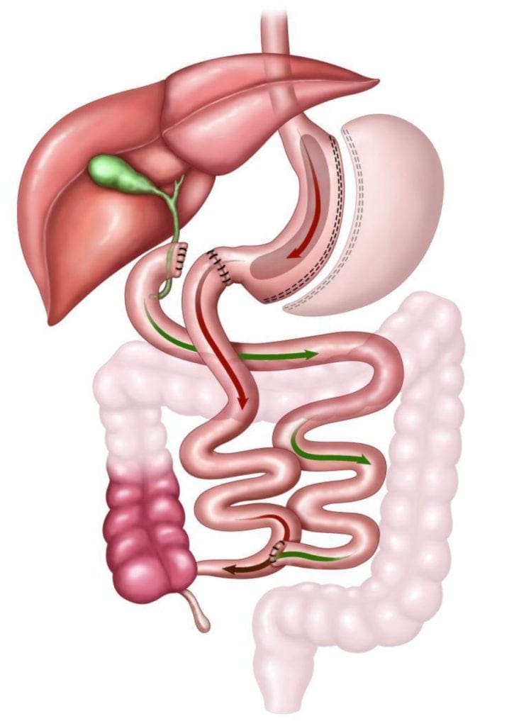 SIPS procedure is based on duodenal switch