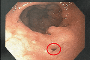 endoscopic view of staple line leaks after bariatric surgery