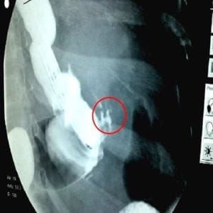upper GI of a staple line leaks after bariatric surgery