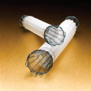 esophageal stents used to treat staple line leaks after bariatric surgery