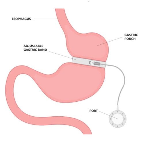 Gastric Band Vitamins