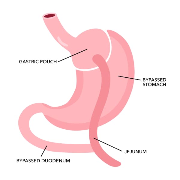 gastric bypass anatomy