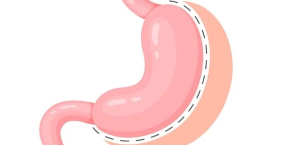 gastric sleeve