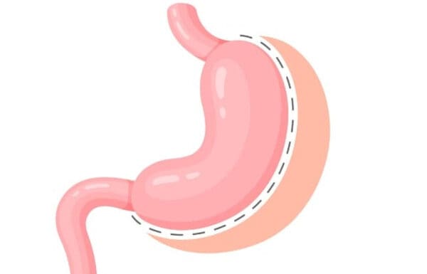 gastric sleeve