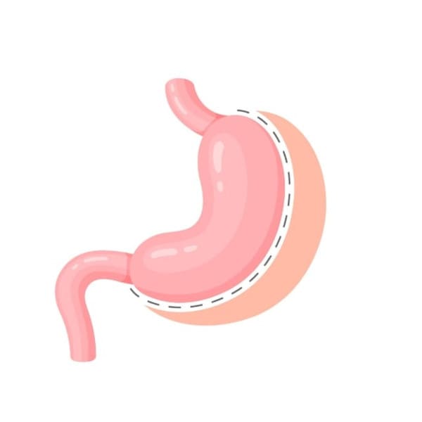 gastric sleeve