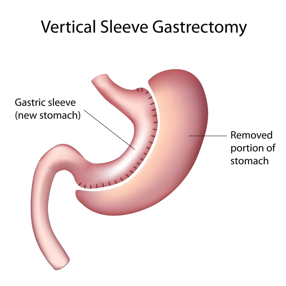 vertical sleeve gastrectomy