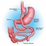 gastric bypass anatomy