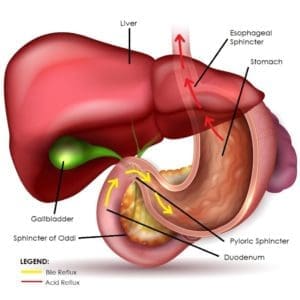 bile reflux gastritis