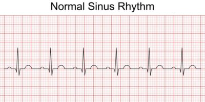 EKG 12 lead ekg