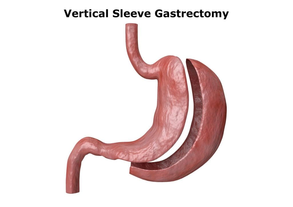 anatomy of gastric sleeve procedure