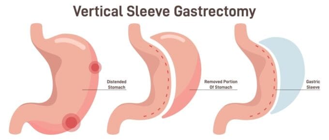 gastric sleeve anatomy vsg surgery