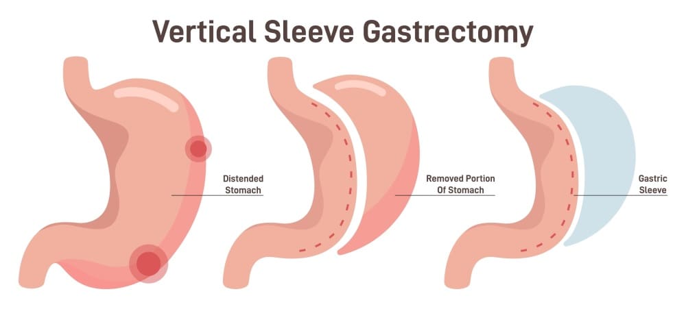 gastric sleeve anatomy vsg surgery