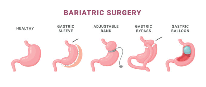 gastric bypass versus gastric sleeve