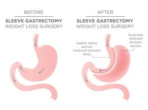 gastric sleeve/VSG anatomy