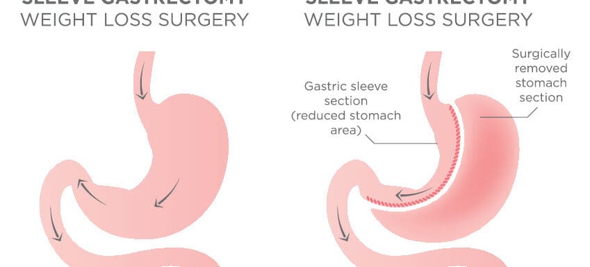 gastric sleeve/VSG anatomy