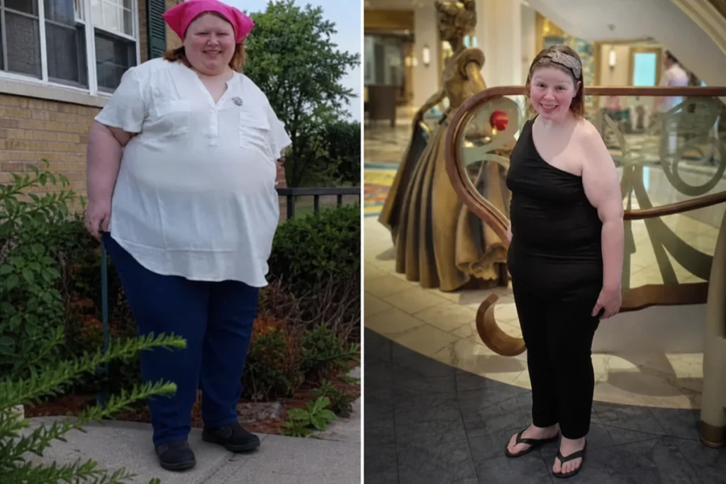 Julie before and after gastric sleeve surgery showing her 202-pound weight-loss result at JourneyLite