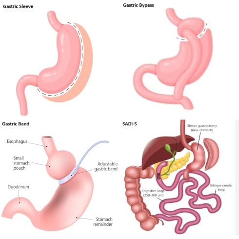 Surgical Pre-op Navigator Post-op Diet Progression/Sleeve-Bypass-SIPS ...