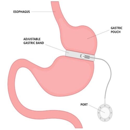 gastric band anatomy