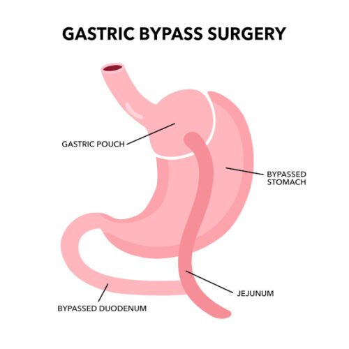 gastric bypass surgery illustration