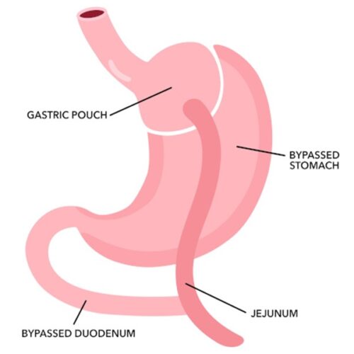 gastric bypass anatomy