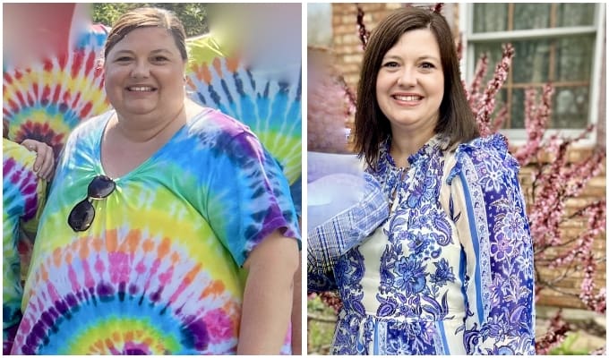 Gastric sleeve before and after