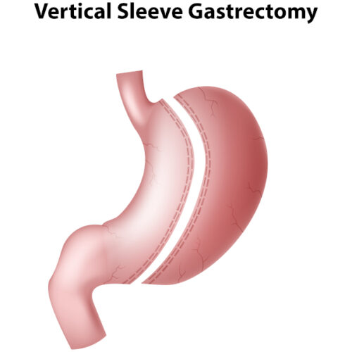 gastric sleeve anatomy