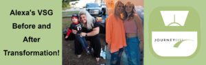 alexa before and after gastric sleeve at journeylite