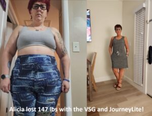 Alicia's VSG before and after pictures at JourneyLite
