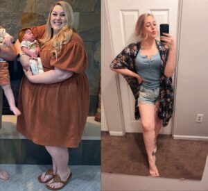 callie before and after losing 187 pounds with gastric sleeve surgery