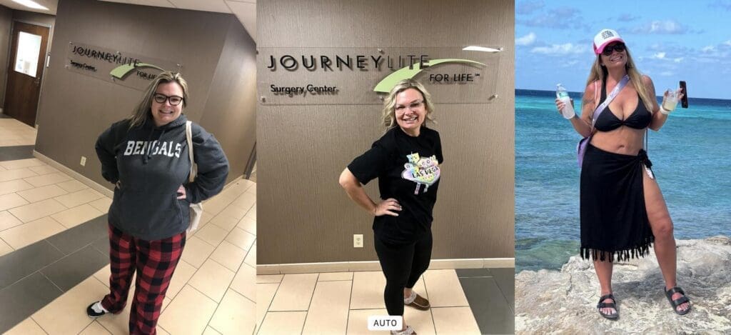 Jennifer before and after gastric sleeve surgery