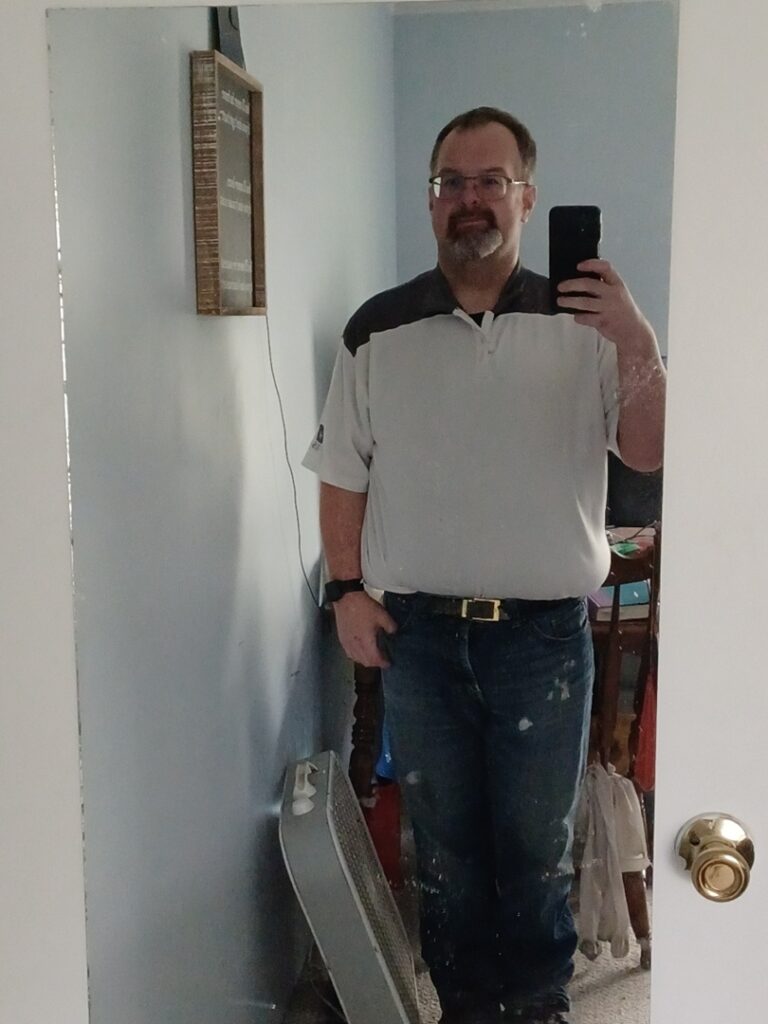 jonathon after gastric sleeve (VSG)