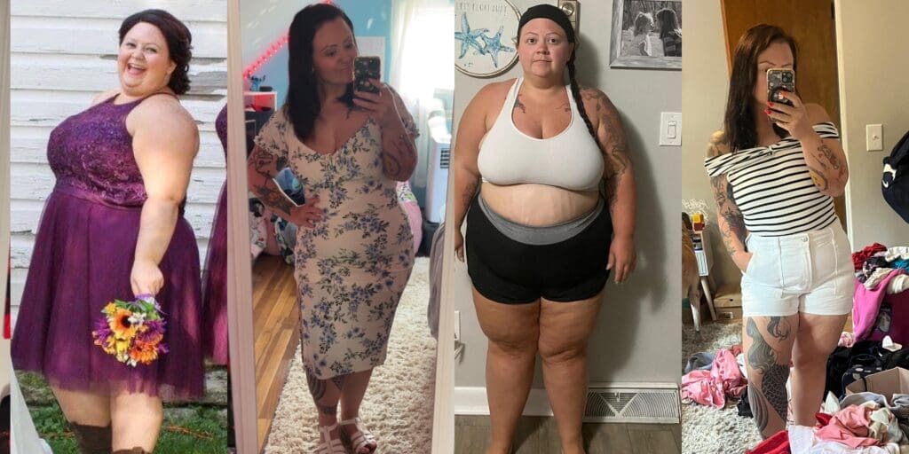 Kayla before and after gastric sleeve surgery