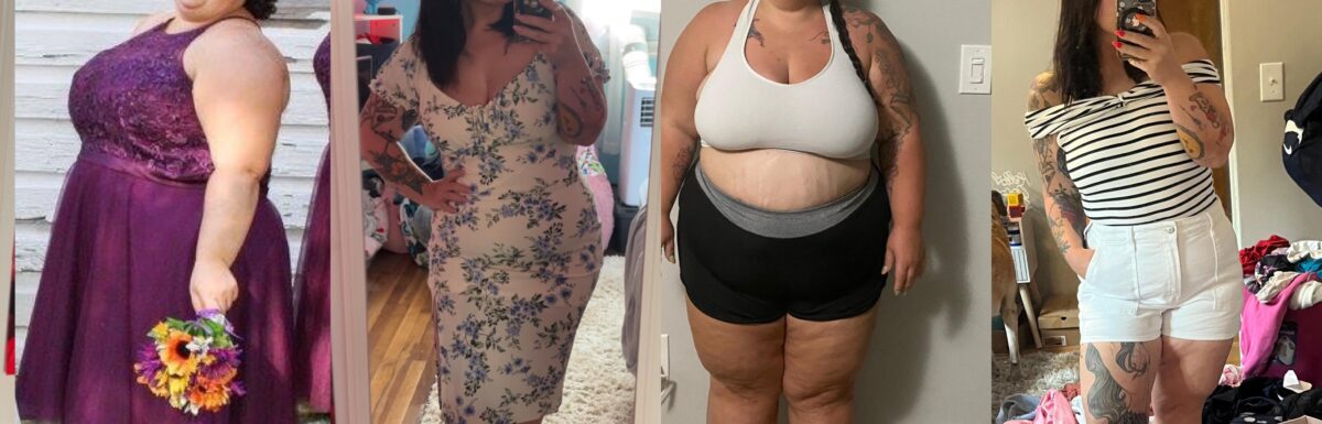VSG before and after pictures of Kayla