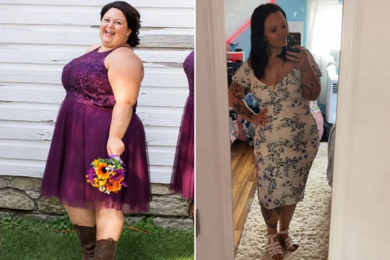 Kayla before and after gastric sleeve surgery showing her 120-pound weight loss at JourneyLite
