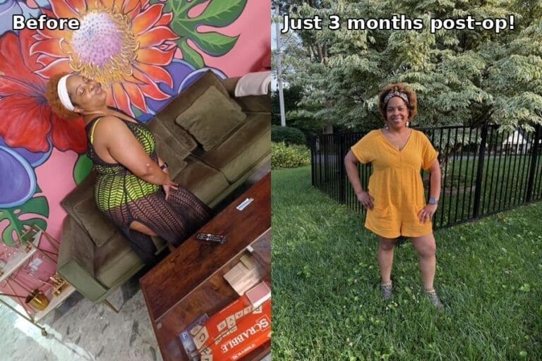 Alona before and after gastric sleeve surgery