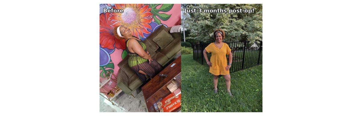 Alona before and after VSG featured