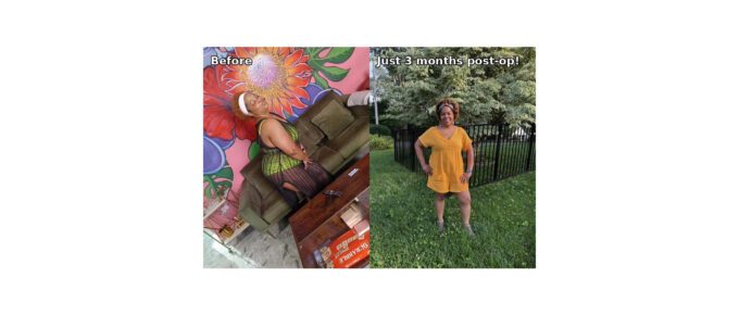 Alona before and after VSG featured