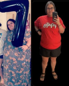 Mindy's JourneyLite VSG before and after picture