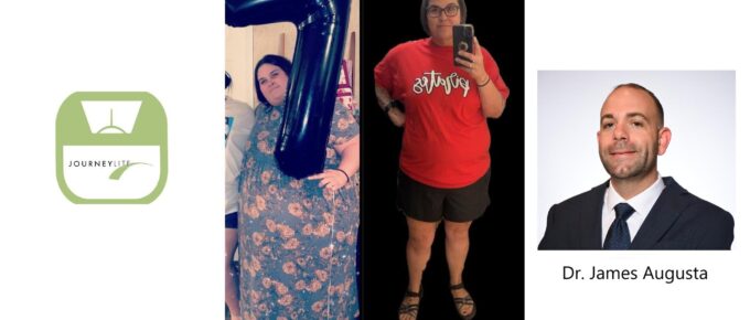 Mindy's VSG before and after story