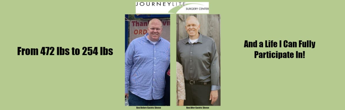 Ben’s gastric sleeve success at JourneyLite—before at 472 lbs and after at 254 lbs, side-by-side.