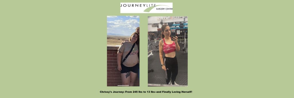 Chrissy before and after gastric sleeve surgery
