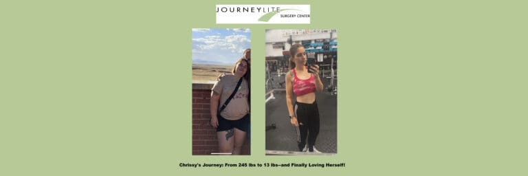 Chrissy before and after gastric sleeve surgery