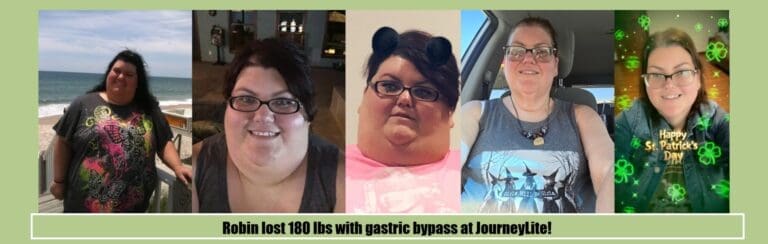Robin before and after gastric bypass surgery