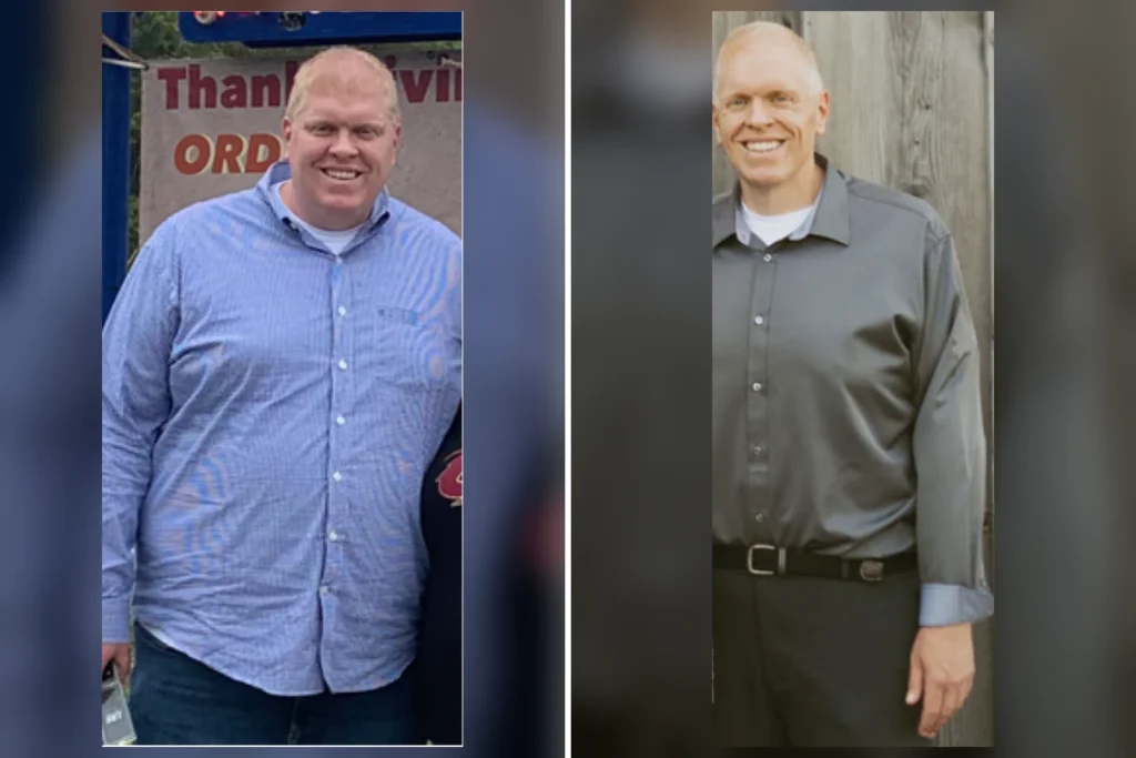 Ben before and after gastric sleeve surgery showing his 218-pound weight loss at JourneyLite