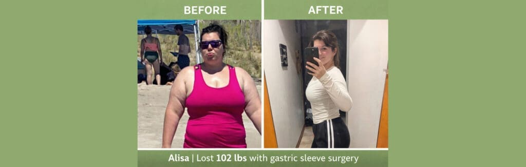Before-and-after weight loss photos of Alisa following gastric sleeve surgery at JourneyLite, showing significant transformation from 252 pounds to 150 pounds.