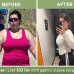 Before-and-after weight loss photos of Alisa following gastric sleeve surgery at JourneyLite, showing significant transformation from 252 pounds to 150 pounds.