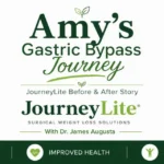 Amy’s before and after gastric bypass transformation with JourneyLite and Dr. James Augusta after band to gastric bypass conversion.