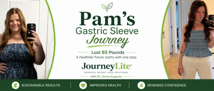 Pam gastric sleeve before and after JourneyLite VSG weight loss transformation