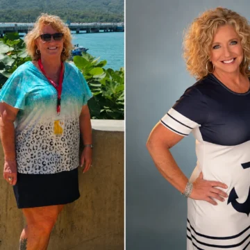 Amy before and after band to gastric bypass conversion at JourneyLite